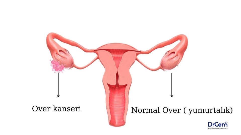 Over Neoplazileri görseli - DrCem hastalık rehberi